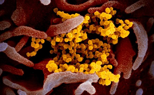 This colorized transmission electron micrograph image shows SARS-CoV-2, the coronavirus that causes the disease COVID-19. This specimen was isolated from a patient in the United States. Particles of the virus (yellow) are emerging from the surface of cell This colorized transmission electron micrograph image shows SARS-CoV-2, the coronavirus that causes the disease COVID-19. This specimen was isolated from a patient in the United States. Particles of the virus (yellow) are emerging from the surface of cell
