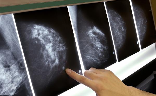 In a study of 1.3 million women, ages 40 to 74, having a false positive on a screening mammogram was associated with a slightly increased chance that the woman would eventually develop breast cancer. The extra risk seemed to be independent of the density In a study of 1.3 million women, ages 40 to 74, having a false positive on a screening mammogram was associated with a slightly increased chance that the woman would eventually develop breast cancer. The extra risk seemed to be independent of the density