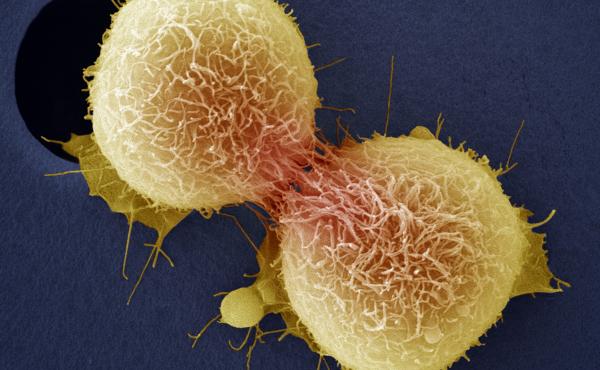 Cancer of the cervix is one of the most common cancers affecting women and can be fatal. Here, cervical cancer cells are dividing, as seen through a colored scanning electron micrograph. Cancer of the cervix is one of the most common cancers affecting women and can be fatal. Here, cervical cancer cells are dividing, as seen through a colored scanning electron micrograph.