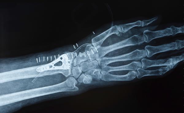 A man who breaks a wrist after age 50 is more likely to die prematurely than a woman with the same injury. A man who breaks a wrist after age 50 is more likely to die prematurely than a woman with the same injury.