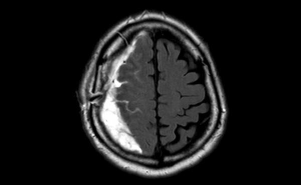 An MRI scan shows Bryan Arling's brain from above. The white-looking fluid is a subdural hematoma, or a collection of blood, that pushed part of his brain away from the skull, causing headaches and slowing his decision-making. An MRI scan shows Bryan Arling's brain from above. The white-looking fluid is a subdural hematoma, or a collection of blood, that pushed part of his brain away from the skull, causing headaches and slowing his decision-making.