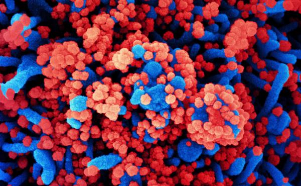 SARS-CoV-2 virus particles, shown in red, have heavily infected a cell in this colorized scanning electron micrograph. SARS-CoV-2 is the virus that causes COVID-19. SARS-CoV-2 virus particles, shown in red, have heavily infected a cell in this colorized scanning electron micrograph. SARS-CoV-2 is the virus that causes COVID-19.