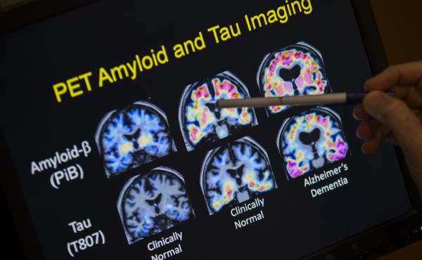 In a May 19, 2015 file photo, R. Scott Turner, Professor of Neurology and Director of the Memory Disorder Center at Georgetown University Hospital, points to PET scan results that are part of a study on Alzheimer's disease at Georgetown University Hospita In a May 19, 2015 file photo, R. Scott Turner, Professor of Neurology and Director of the Memory Disorder Center at Georgetown University Hospital, points to PET scan results that are part of a study on Alzheimer's disease at Georgetown University Hospita