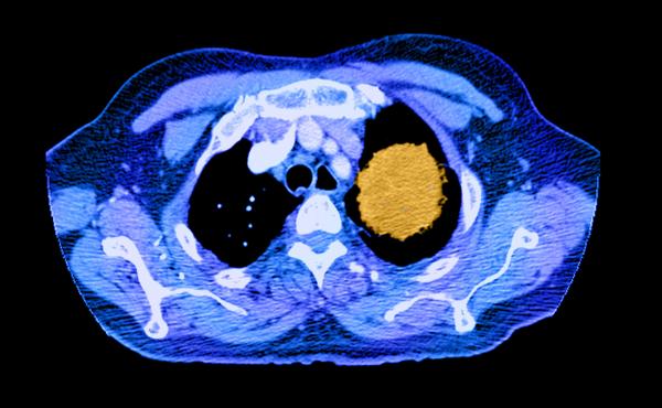 A color-enhanced spiral CT image of the chest shows a large cancerous mass (in yellow) in the left upper lobe. A color-enhanced spiral CT image of the chest shows a large cancerous mass (in yellow) in the left upper lobe.