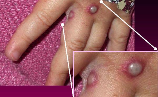 Symptoms of the monkeypox virus are shown on a patient's hand, from a 2003 case in the United States. In most instances, the disease causes fever and painful, pus-filled blisters. New cases in the United Kingdom, Spain and Portugal are spreading possibly Symptoms of the monkeypox virus are shown on a patient's hand, from a 2003 case in the United States. In most instances, the disease causes fever and painful, pus-filled blisters. New cases in the United Kingdom, Spain and Portugal are spreading possibly