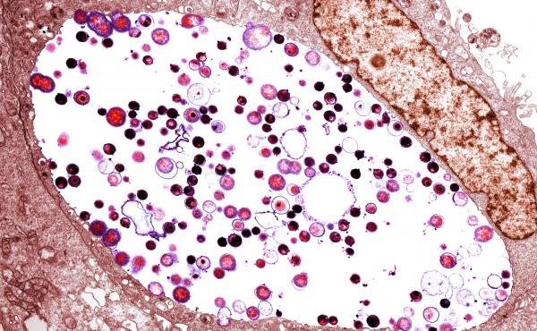 A tinted transmission electron micrograph of Chlamydia trachomatis bacteria (light purple/black) inside a cell. Chlamydia is the most common sexually transmitted disease in the U.S., with more than 1.7 million reported cases in 2017. A tinted transmission electron micrograph of Chlamydia trachomatis bacteria (light purple/black) inside a cell. Chlamydia is the most common sexually transmitted disease in the U.S., with more than 1.7 million reported cases in 2017.