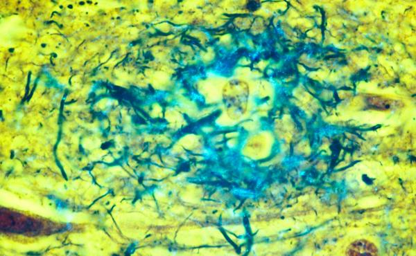 Plaques located in the gray matter of the brain are key indicators of Alzheimer's disease. Plaques located in the gray matter of the brain are key indicators of Alzheimer's disease.
