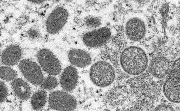 This 2003 electron microscope image made available by the Centers for Disease Control and Prevention shows mature, oval-shaped monkeypox virions, left, and spherical immature virions, right, obtained from a sample of human skin associated with the 2003 pr This 2003 electron microscope image made available by the Centers for Disease Control and Prevention shows mature, oval-shaped monkeypox virions, left, and spherical immature virions, right, obtained from a sample of human skin associated with the 2003 pr