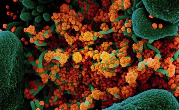A colorized scanning electron micrograph of a cell (green) heavily infected with particles (orange) from the virus that causes COVID-19, isolated from a patient sample. A colorized scanning electron micrograph of a cell (green) heavily infected with particles (orange) from the virus that causes COVID-19, isolated from a patient sample.