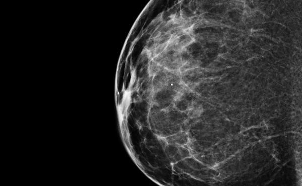 A 3-D mammogram reveals a normal breast. A 3-D mammogram reveals a normal breast.
