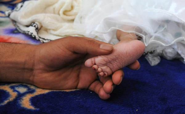 A malnourished child receives medical treatment in Sanaa, Yemen. A malnourished child receives medical treatment in Sanaa, Yemen.