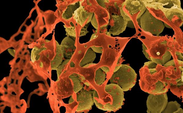 MRSA, depicted above in yellow and surrounded by cellular debris, is the name of a staph bacteria that resists treatment by many common antibiotics. The image is from a scanning electron micrograph. MRSA stands for methicillin-resistant Staphylococcus aur MRSA, depicted above in yellow and surrounded by cellular debris, is the name of a staph bacteria that resists treatment by many common antibiotics. The image is from a scanning electron micrograph. MRSA stands for methicillin-resistant Staphylococcus aur